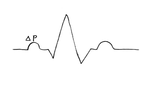An ECG with 'Δp' above the P wave